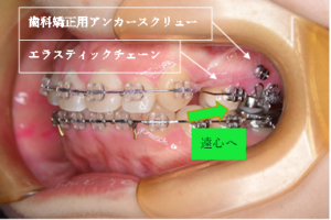 歯科矯正用アンカースクリューによる固定