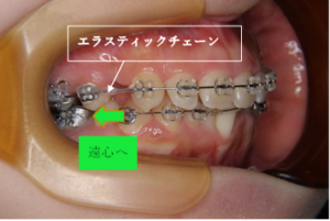 顎内固定、エラスティックチェーン