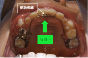 補助弾線付きリンガルアーチ、顎内固定